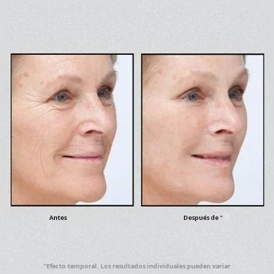 Reafirmante facial temporal